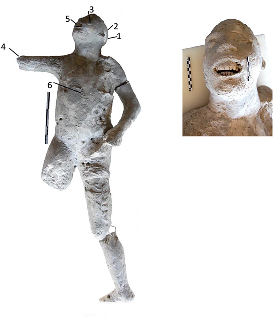 Victim 57. Cast #57 and pXRF measuring points (1–6).
The cast #57 is an adult individual (25–30 years old). He was found supine and has some flexed or lopsided anatomical areas. 
The skull is inclined to the right and the chest is straight, presenting its coxofemoral joint slightly rotated towards its medial aspect.
The cast #57 shows dental wear of the incisors and canines of the upper jaw, product of its axial shaft, and erosion of the lower incisors. 
Photo courtesy of The Casts of Pompeii Project. Use subject to CC BY 4.0 Deed 
See Alapont L, Gallello G, Martinón-Torres M, Osanna M, Amoretti V, Chenery S, et al. (2023) The casts of Pompeii: Post-depositional methodological insights. PLoS ONE 18(8): e0289378, Fig 2. https://doi.org/10.1371/journal.pone.0289378 
Victim 57 is a young male aged 13-19 years.
Some imprints of the fabric of a tunic are visible near the side and the left thigh.
The body was found between the 2nd of August and the 21st of September 1976, outside the Porta Nola near the tomb of M. Obellius Firmus.
See Osanna, N., Capurso, A., e Masseroli, S. M., 2021. I Calchi di Pompei da Giuseppe Fiorelli ad oggi: Studi e Ricerche del PAP 46, p. 454-6, Calco n. 57.