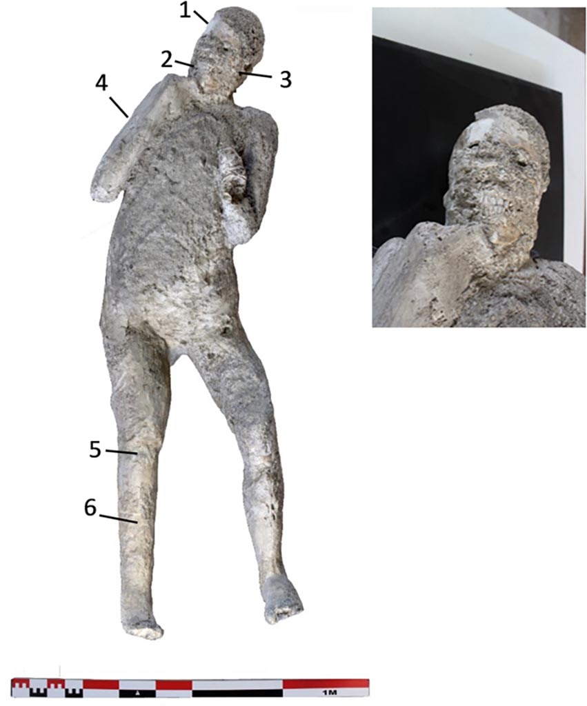 Victim 62. Cast #62 and pXRF measuring points (1–6).
The cast #62 is an adult individual (25–30 years old) identified as female, found interlaced to the left hand-forearm and holding a rope that would go over the left shoulder carrying a sack or bag. The original position of this individual was prone with the head resting on the face.
Photo courtesy of The Casts of Pompeii Project. Use subject to CC BY 4.0 Deed 
See Alapont L, Gallello G, Martinón-Torres M, Osanna M, Amoretti V, Chenery S, et al. (2023) The casts of Pompeii: Post-depositional methodological insights. PLoS ONE 18(8): e0289378, fig. 3. https://doi.org/10.1371/journal.pone.0289378 
Victim 62 is an adult male over 20 years of age.
The cast was found outside Porta Nola near the tomb of M. Obellius Firmus between the 2nd of August and the 21st of September 1976.
On the left forearm the drapery of the sleeve of the robe appears to be legible.
See Osanna, N., Capurso, A., e Masseroli, S. M., 2021. I Calchi di Pompei da Giuseppe Fiorelli ad oggi: Studi e Ricerche del PAP 46, p. 465-6, Calco n. 62.