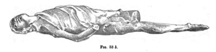 Villa della Pisanella, Boscoreale. Cast of supine man.
See Notizie degli Scavi di Antichità, 1895, Fig.53b.